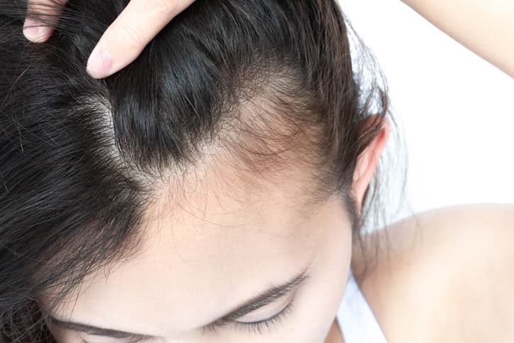 Hair Regeneration in London and Surrey: Mesotherapy for Thinning Hair and Hair Loss