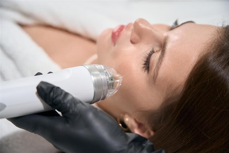 Micro-Needling with PRP in London – What to Expect & Real Benefits